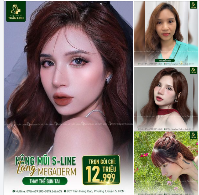 NÂNG MŨI SLINE TẶNG NGAY BỌC MEGADERM ( thay thế sụn tai) 