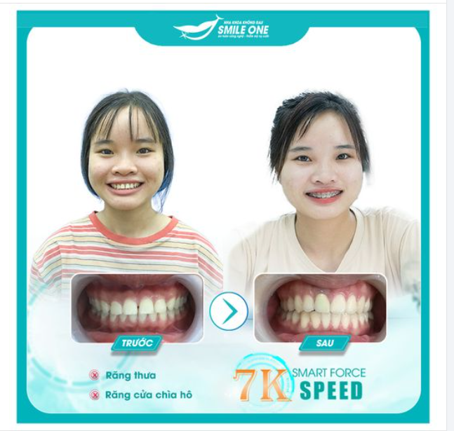 TOP 4 CÁCH KHẮC PHỤC RĂNG THƯA HIỆU QUẢ BẠN NÊN BIẾT?