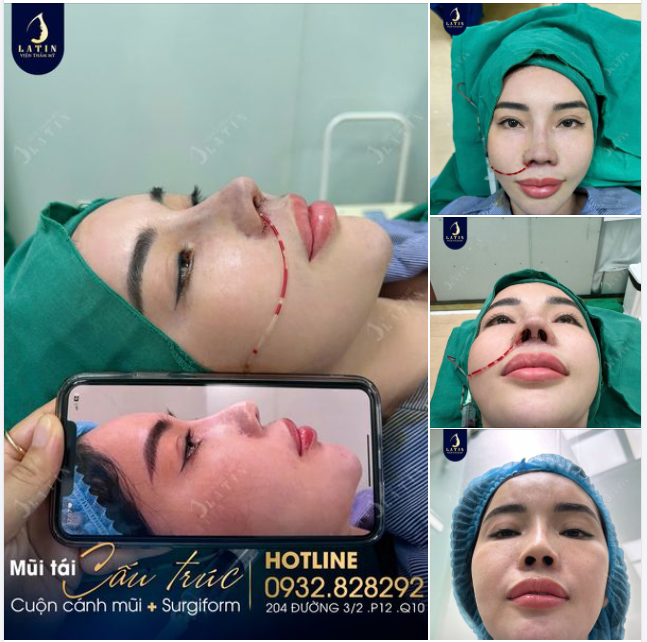 Tạo hình dáng mũi mới theo mong muốn cho chị gái N.L