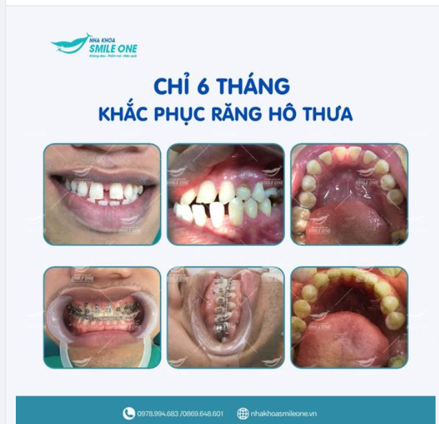 “CƯỜI THÌ CHE CÁI MỒM LẠI KHÔNG GIÓ LÙA”
