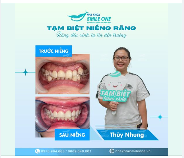 Chúc mừng Thùy Nhung đã về đích xuất sắc trên hành trình niềng răng của mình!