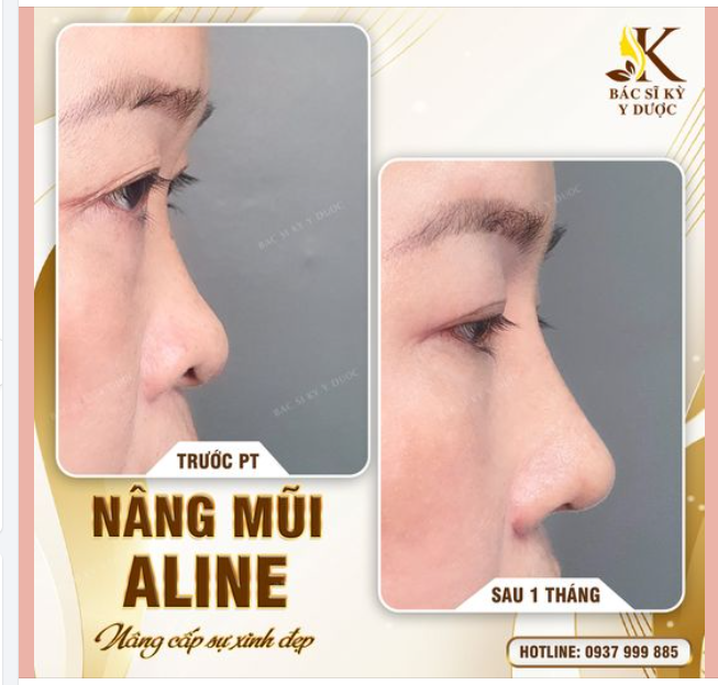 Đủ thời gian để mũi "gom form" vào dáng Xem thêm nâng mũi