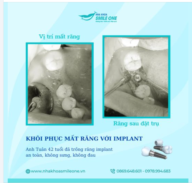 PHỤC HÌNH RĂNG MẤT ĂN NHAI NHƯ RĂNG THẬT