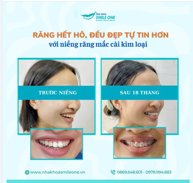 ĐỪNG ĐỂ RĂNG HÔ LÀM BẠN MẤT TỰ TIN, NIỀNG NGAY THÔI!
