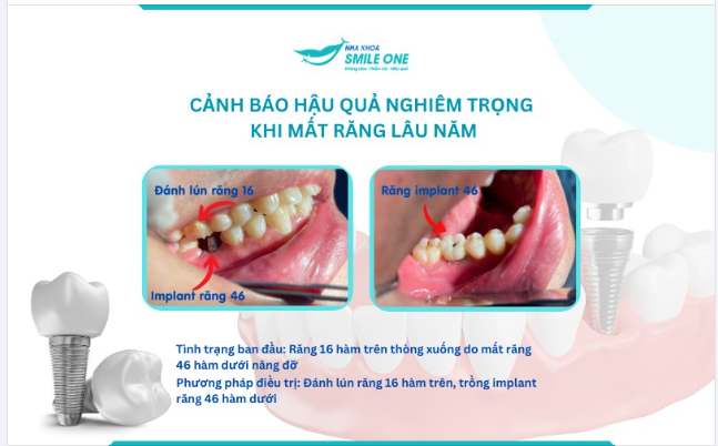 MẤT TIỀN OAN CHỈ VÌ NGÓ LƠ CHIẾC RĂNG ĐÃ MẤT LÂU NĂM