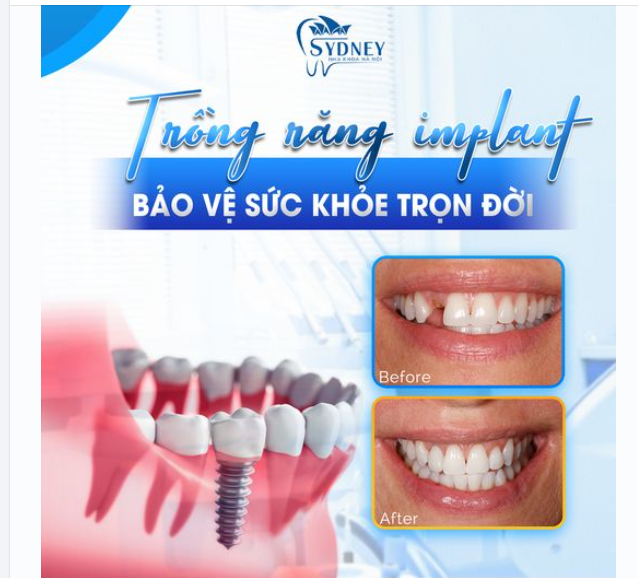 TRỒNG RĂNG IMPLANT - BẢO VỆ SỨC KHỎE TRỌN ĐỜI