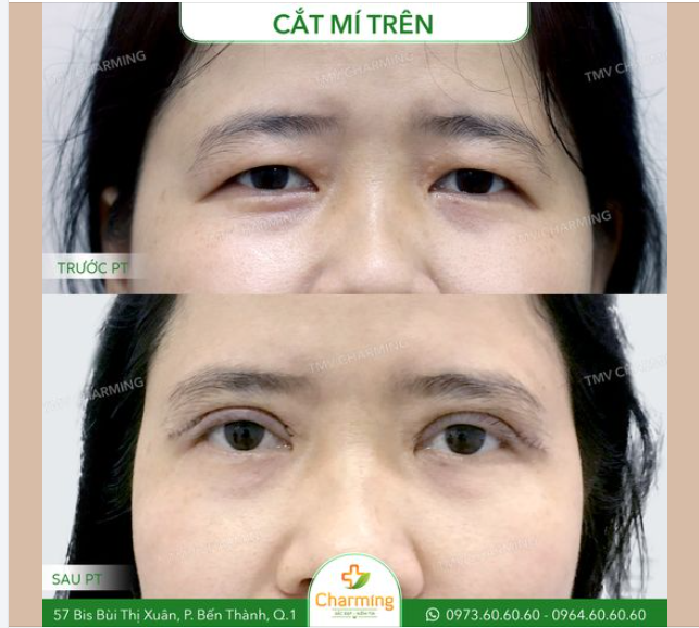 Trước khi thực hiện cắt mí trên, nàng khách gặp phải tình trạng mí trên sụp xệ, với da chùng nhiều khiến đôi mắt trông mệt mỏi và gương mặt có phần già dặn hơn so với tuổi.