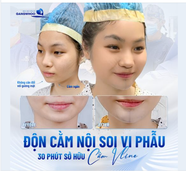 KHẮC PHỤC CẰM NGẮN, LẸM CHỈ SAU 30 PHÚT