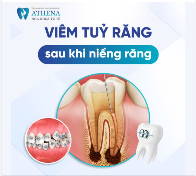 Trong quá trình niềng răng, nếu không chú ý chăm sóc kỹ lưỡng hoặc răng gặp vấn đề trước đó, nguy cơ viêm tủy có thể tăng lên.