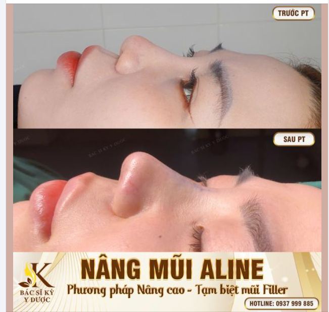 NÂNG MŨI “VỪA ĐỦ” là sao bác sĩ?
