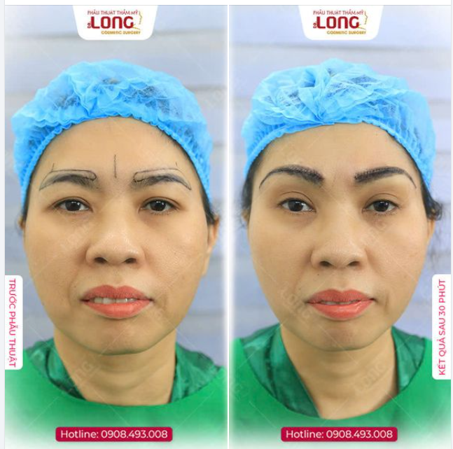 1 LẦN TREO CHÂN MÀY - HẾT U SẦU NGAY