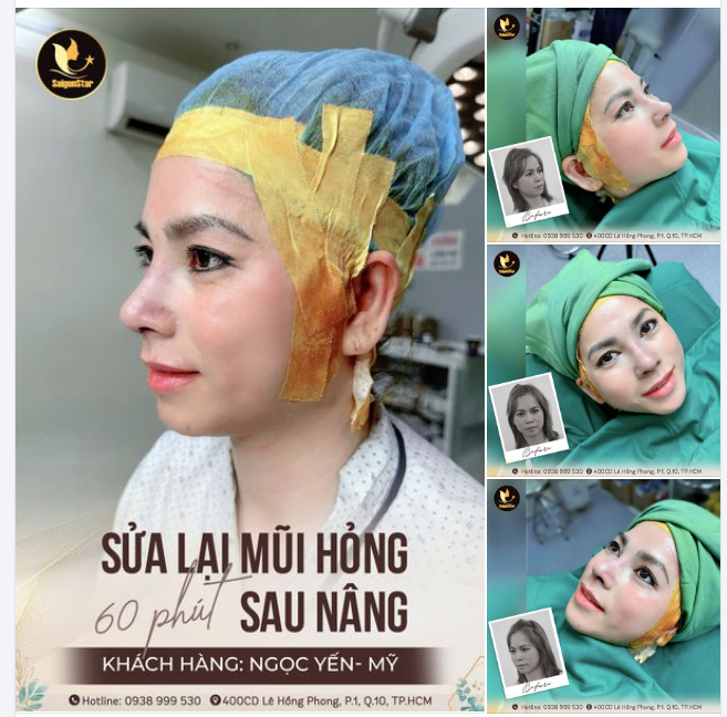 Vậy thì mời cả nhà cùng chiêm ngưỡng sự lột xác sau 60 phút NÂNG MŨI CẤU TRÚC SỬA LẠI của chị Ngọc Yến (Việt kiều Mỹ) để yên tâm gửi gắm niềm tin nơi Bác Hoạt nhé!