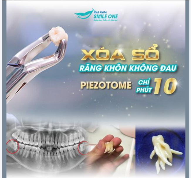 "XÓA SỔ" RĂNG KHÔN KHÔNG ĐAU, CHỈ SAU 10 PHÚT VỚI MÁY PIEZOTOME