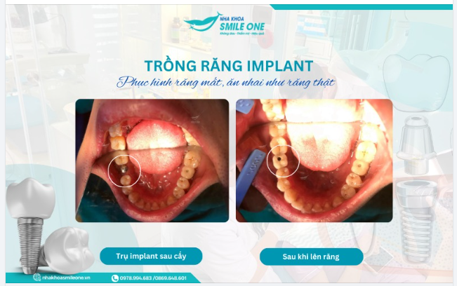 PHỤC HÌNH RĂNG MẤT, ĂN NHAI NHƯ RĂNG THẬT