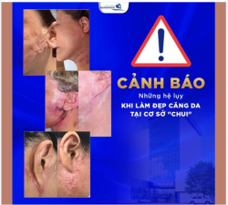 GÓC CẢNH BÁO: NGUY CƠ GÂY BIẾN CHỨNG KHI LÀM ĐẸP CĂNG DA MẶT TẠI CÁC CƠ SỞ THẨM MỸ “CHUI”