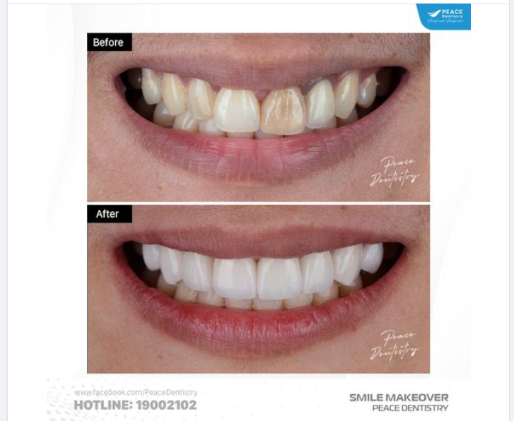 BỌC SỨ & DÁN SỨ ĐIỂM KHÁC BIỆT VÀ LƯU Ý QUAN TRỌNG