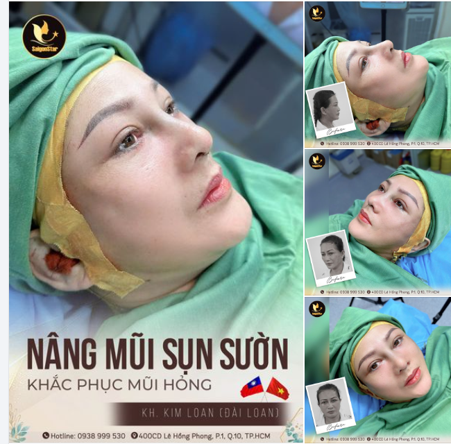 KHẮC PHỤC MŨI HỎNG - TÁI TẠO DÁNG MŨI ĐẸP TỰ NHIÊN