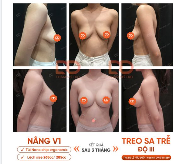 CHẢY XỆ KIỂU NÀO - TREO KIỂU ĐẤY