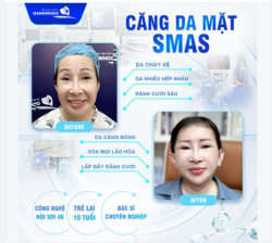 CĂNG DA MẶT SMAS NỘI SOI 4K CHÌA KHÓA CHO LÀN DA LUÔN TRẺ XÓA MỌI NẾP NHĂN