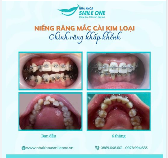 6 THÁNG THAY ĐỔI “DIỆN MẠO MỚI” CHO NỤ CƯỜI