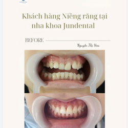 Nhật ký niềng răng  Khách hàng: Nguyễn Thị Hoa đến từ Thanh Hóa