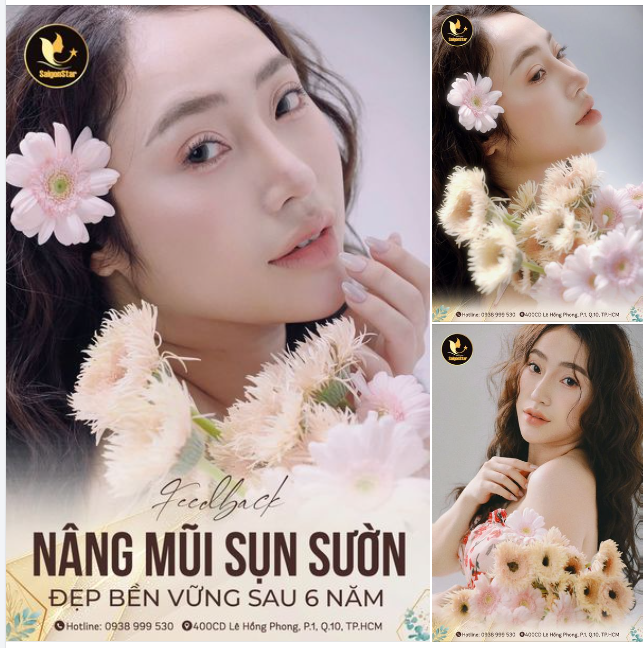 ĐẸP BỀN VỮNG SAU 6 NĂM NÂNG MŨI SỤN SƯỜN
