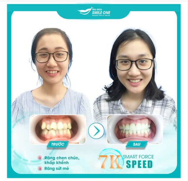 NHỮNG TƯỚNG RĂNG XẤU ẢNH HƯỞNG ĐẾN TÀI LỘC