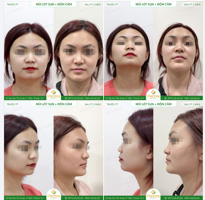 Trước khi đến với TMV Charming, nàng gặp phải tình trạng cằm thô và thiếu độ nhô, khiến gương mặt không được thanh thoát và trông mất cân đối.