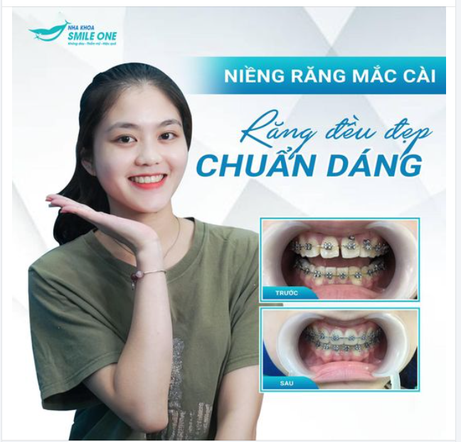 RĂNG ĐỀU ĐẸP, CHUẨN GIRL XINH