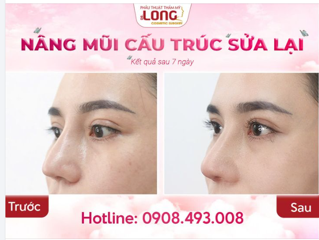GIẢI CỨU MŨI HỎNG - TỔNG THỂ HẾT BAO NHIÊU?