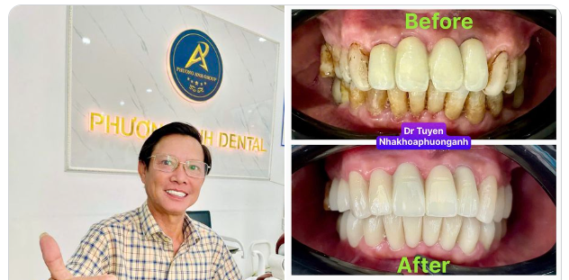Tạm biệt hàm răng nhiễm màu, nhiều mảng bám, hình thể xấu, ăn nhai khó khăn, khiến nụ cười kém duyên, khiến gương mặt bạn già hơn so với tuổi …