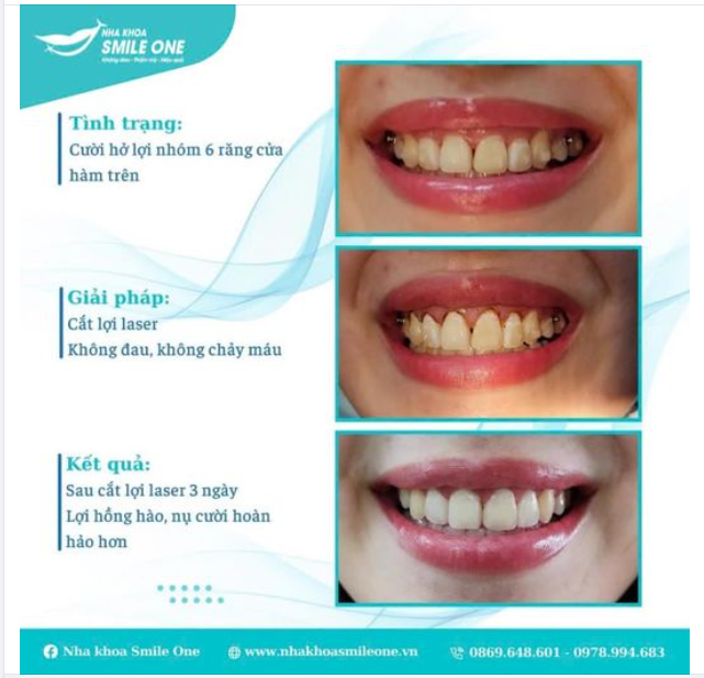 BẠN SẼ ĐẸP HƠN NẾU KHÔNG CÒN CƯỜI HỞ LỢI