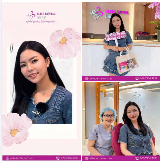 “Mình không nghĩ là niềng răng còn có thể giúp khuôn mặt mình thay đổi nhiều đến thế. Lần về quê vừa rồi mọi người trong nhà phải thừa nhận là không nhận ra mình luôn.” - Chị Minh Huệ