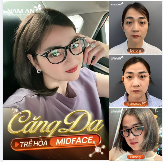 CĂNG DA TRẺ HÓA MIDFACE