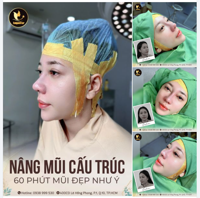 NÂNG MŨI CẤU TRÚC - BÍ QUYẾT "LỘT XÁC" DÁNG MŨI CHỈ SAU 60 PHÚT