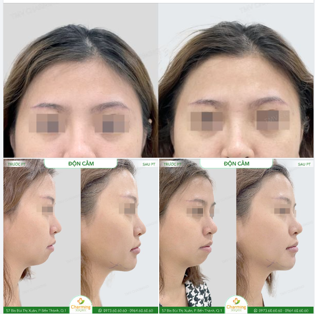 Trước khi thực hiện phẫu thuật độn cằm, nàng khách luôn cảm thấy thiếu tự tin về chiếc cằm của mình.