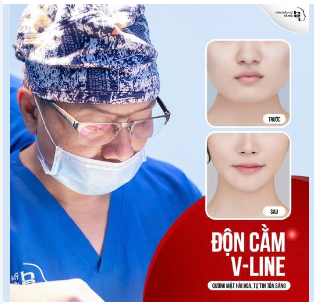 ĐỘN CẰM V-LINE Gương mặt HÀI HOÀ, tự tin TOẢ SÁNG