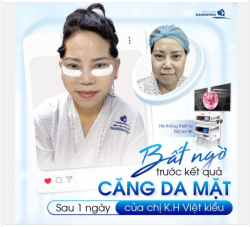 Vùng da thừa trên gương mặt chảy xệ ​​​​​​​ Da thừa hoàn toàn được loại bỏ