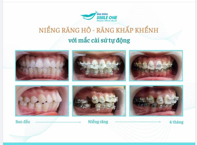 HÀNH TRÌNH 6 THÁNG KHẮC PHỤC RĂNG HÔ VỚI MẮC CÀI SỨ TỰ ĐỘNG