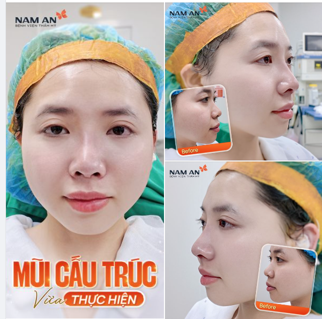 DÁNG MŨI CẤU TRÚC VỪA PHẪU THUẬT