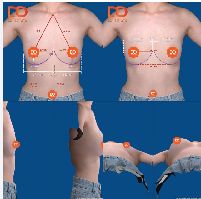 Hình ảnh thực tế mô phỏng kết quả phẫu thuật trước nâng bằng công nghệ VECTRA XT PLUS.