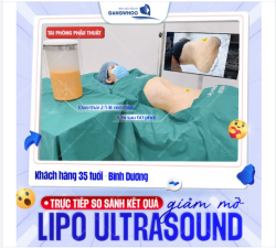 SO SÁNH KẾT QUẢ GIẢM MỠ LIPO ULTRASOUND TẠI PHÒNG PHẪU THUẬT