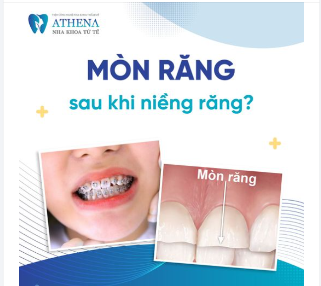 Mòn răng sau khi niềng là một tình trạng ít gặp, nhưng vẫn có thể xảy ra nếu không được chăm sóc đúng cách trong quá trình chỉnh nha.