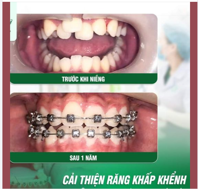 CẢI THIỆN RĂNG KHẤP KHỂNH - CƯỜI TỰ TIN VỚI HÀM RĂNG ĐỀU ĐẸP