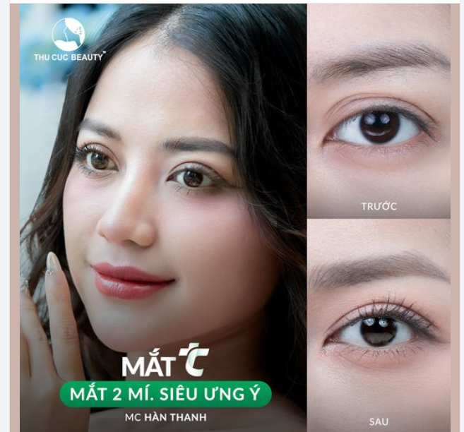 Da chùng/đa nếp mí khiến bạn mất tự tin? Tới Thu Cúc cắt mí ngay trong tháng này