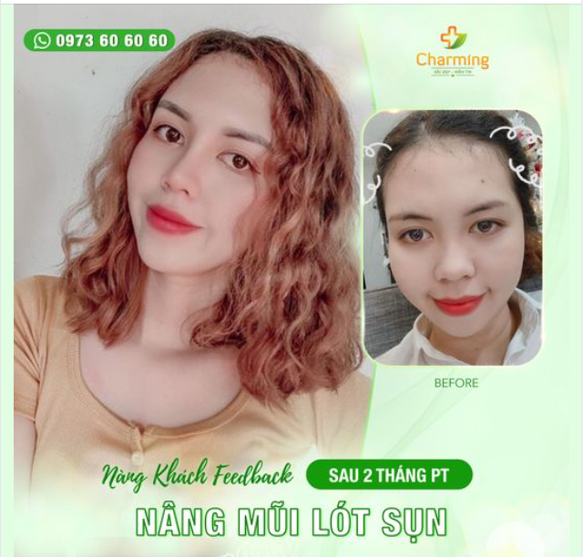 Chúng ta vừa chào đón một nàng khách cực kỳ xinh đẹp với chiếc mũi mới tinh tế sau khi nâng mũi lót sụn tại Charming.