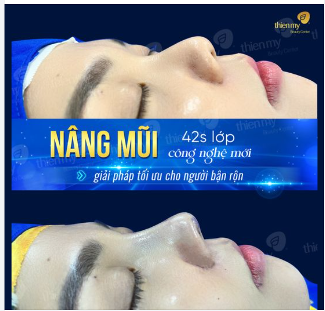 Feedback Những hình ảnh chân thực của khách hàng sau khi nâng mũi tại PKCK Thiện Mỹ giúp khách hàng thăng hạng nhan sắc.