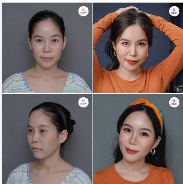 SỰ KẾT HỢP CỦA CẤY MỠ - TIÊM PROFHILO MANG LẠI HIỆU QUẢ TRẺ HÓA NHƯ THẾ NÀO?