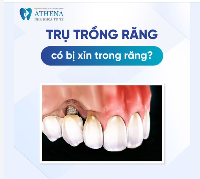 Trụ implan có bị xỉn màu không?