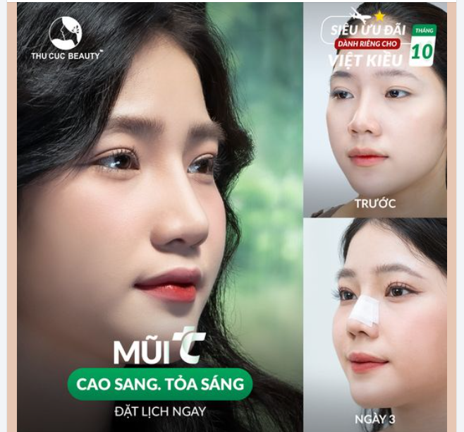 Khách Hàng Việt Kiều muốn xóa sổ tình trạng cánh mũi to bè 